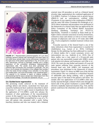 Alt et al. Adipose-derived regenerative cells
25
FIGURE 27  Representative photomicrographs of 5 µm thick
histologic sections (stained with hematoxylin and eosin stain) of
the small tissue sample taken during arthroscopic inspection of
the right knee of the patient represented in Fig. 24 at one year
after arthroscopic removal of damaged cartilage and a single
application of the unmodified autologous adipose-derived
regenerative cells. The panels (b,d) were generated with
polarized light microscopy and converted to grayscale. The red
lines in (b,d) indicate the orientation of the collagen fiber bundles
within the newly formed cartilage (more vertically in in the deep
and middle layers, and more horizontally in the superficial layer).
The asterisk in (c) indicates a region of original cartilage,
demonstrating that the tissue sample was indeed taken from the
newly formed cartilage. The scale bar represents 100 µm.
5.4. Guided bone regeneration
The promising results achieved in the treatment of
cartilage defects and chronic, recalcitrant low back pain
caused by lumbosacral facet syndrome (described in detail
in Sections 5.1. and 5.2.) gave reason to hypothesize that
the application of UA-ADRCs could also advance the
treatment of other pathologies of the musculoskeletal
system. In this regard it was a key finding that in guided
bone regeneration (GBR) (exemplified by a case of a 79-
year old patient who presented with a partly failing
maxillary dentition and who was treated with a bilateral
external sinus lift procedure as well as a bilateral lateral
alveolar ridge augmentation) the combined application of
UA-ADRCs, Fraction 2 of plasma rich in growth factors
(PRGF-2) and an osteoinductive scaffold (OIS)
(Treatment A) was superior to the combination of PRGF-2
and the same OIS alone (Treatment B) (Solakoglu et al.,
2019) (these treatments and procedures were performed in
the framework of a clinical study that was approved by the
Ethics Committee of the Federal Dental Association
Hamburg (Hamburg, Germany) (no. PV5211)).
Specifically, Treatment A resulted in faster build up of
higher relative amounts (area/area) of newly formed bone,
connective tissue and arteries as well as in lower relative
amounts of adipocytes and veins at 34 weeks after GBR
(Fig. 31a,b) comparted to standard treatment without stem
cells.
Avascular necrosis of the femoral head is one of the
many indications where bone regeneration is essential for
rehabilitation (e.g., Larson et al., 2018). Cell-based
therapy for this pathology has been addressed in a number
of clinical studies (for a recent systematic review and
meta-analysis see, e.g., Andriolo et al., 2018). One of
these studies was a case report of a 43-year-old male
patient who was successfully treated with ADRCs mixed
with platelet-rich plasma and hyaluronic acid (Pak et al.,
2014). We went one step further and treated a 41-year-old
male patient suffering from avascular necrosis of the
femoral head only with ADRCs (all treatments and
procedures were performed in the framework of clinical
assessment). Figure 31c shows an MRI scan of the left hip
of this patient who was confined to a wheelchair because
of unbearable pain during walking, with a significant
necrotic space in the head of the patient’s left femur. Six
months after two applications of UA-ADRCs (that were
locally injected through a channel which came through the
lateral side of the greater trochanter) a control MRI scan
showed a markedly improved situation (Fig. 31d), and the
patient could leave the wheelchair and walks now without
pain.
Preprints (www.preprints.org) | NOT PEER-REVIEWED | Posted: 17 April 2019 doi:10.20944/preprints201904.0200.v1
 