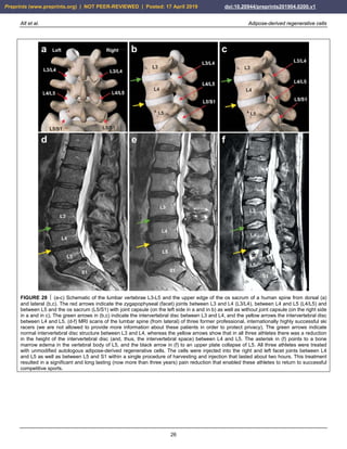 Alt et al. Adipose-derived regenerative cells
26
FIGURE 28  (a-c) Schematic of the lumbar vertebrae L3-L5 and the upper edge of the os sacrum of a human spine from dorsal (a)
and lateral (b,c). The red arrows indicate the zygapophyseal (facet) joints between L3 and L4 (L3/L4), between L4 and L5 (L4/L5) and
between L5 and the os sacrum (L5/S1) with joint capsule (on the left side in a and in b) as well as without joint capsule (on the right side
in a and in c). The green arrows in (b,c) indicate the intervertebral disc between L3 and L4, and the yellow arrows the intervertebral disc
between L4 and L5. (d-f) MRI scans of the lumbar spine (from lateral) of three former professional, internationally highly successful ski
racers (we are not allowed to provide more information about these patients in order to protect privacy). The green arrows indicate
normal intervertebral disc structure between L3 and L4, whereas the yellow arrows show that in all three athletes there was a reduction
in the height of the intervertebral disc (and, thus, the intervertebral space) between L4 and L5. The asterisk in (f) points to a bone
marrow edema in the vertebral body of L5, and the black arrow in (f) to an upper plate collapse of L5. All three athletes were treated
with unmodified autologous adipose-derived regenerative cells. The cells were injected into the right and left facet joints between L4
and L5 as well as between L5 and S1 within a single procedure of harvesting and injection that lasted about two hours. This treatment
resulted in a significant and long lasting (now more than three years) pain reduction that enabled these athletes to return to successful
competitive sports.
Preprints (www.preprints.org) | NOT PEER-REVIEWED | Posted: 17 April 2019 doi:10.20944/preprints201904.0200.v1
 