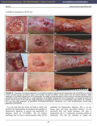 Alt et al. Adipose-derived regenerative cells
29
available for all patients in the EU too.
FIGURE 32  Examples of successful application of unmodified autologous adipose-derived regenerative cells (UA-ADRCs) for treating
chronic wounds that did not heal for years. (a-d) Female, 76 year old patient; chronic wound over the medial malleolus; single
application of UA-ADRCs isolated from 30 ml lipoaspirate. (e-h) Male, 82 years old patient; chronic wound on the lower leg caused by a
phosphorus bomb during World War II; single application of UA-ADRCs isolated from 30 ml lipoaspirate. (i-l) Female, 84 years old
patient, chronic wound on the lower leg; single application of UA-ADRCs isolated from 30 ml lipoaspirate. Abbreviations: BL, baseline;
D9, nine days after application of UA-ADRCs; M1/M2/M2.5/M3/M5/M7, one/two/two and a half/ three/five/seven months after
application of UA-ADRCs.
It is our hope that this article will help to clarify and
facilitate the understanding, development and adoption of
Regenerative Medicine in general and specifically of
therapies based on UA-ADRCs. Not all medical
challenges that we face in clinical practice today will be
candidates for Regenerative Medicine. But as we are
facing more and more age-related diseases, we are
convinced that cell based therapies will play a
fundamental role in a continously increasing number of
indications. This has the potential to trigger the
Preprints (www.preprints.org) | NOT PEER-REVIEWED | Posted: 17 April 2019 doi:10.20944/preprints201904.0200.v1
 
