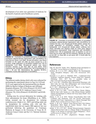 Alt et al. Adipose-derived regenerative cells
30
development of an entire new generation of medicine for
the benefit of patients and of healthcare systems.
FIGURE 33  Examples of successful application of unmodified
autologous adipose-derived regenerative cells (UA-ADRCs) for
reducing scar tissue. (a,b) Male, 48-year-old patient; scar tissue
formation on the upper arm after an injury caused by a car
accident; single application of UA-ADRCs isolated from 100 ml
lipoaspirate. (c,d) Male, 50-years-old patient; scar tissue
formation (arrows) in the face after an acid attack; three
treatments with UA-ADRCs isolated from 100 ml lipoaspirate on
days 1, 90 and 180. Abbreviations: BL, baseline; M1/M12,
one/twelve months after application of UA-ADRCs.
Ethics
The different studies during which cells were collected for
performing the experiments shown in Figs 2-6, 9-20 and
22-23 were approved by the Institutional Review Boards
(IRB) for Baylor College of Medicine and Affiliated
Hospitals (Houston, TX, USA) (Protocol # H-18357) and
University of Texas M. D. Anderson Cancer Center
(Houston, TX, USA) (Protocol # 03-08-03031 and 03-08-
03031).
Killing mice by cervical dislocation for isolating cells
from subcutaneous fat tissue (Muehlberg et al., 2009),
killing neonatal rats by decapitation for isolating
cardiomyocytes (Sadat et al., 2007) and killing adult rats
by decapitation for isolating cells (Alt and Bai,
unpublished data) did not require IRB approval but was
performed following the guidelines of Veterinary
Medicine & Surgery at the University of Texas M. D.
Anderson Cancer Center and the U.S. National Institutes
of Health.
Hallo
FIGURE 34  Examples of successful application of unmodified
autologous adipose-derived regenerative cells (UA-ADRCs) for
treating hair loss. (a,b) 46-year-old female patient; sparse hair;
single application of UA-ADRCs isolated from 100 ml
lipoaspirate. (c-f) 23-years-old female patient suffering from
atopic dermatitis and alopecia totalis for three years without
spontaneous improvement; three treatments with UA-ADRCs
isolated from 100 ml lipoaspirate each at baseline (c) and at
three and six month after the first treatment. Results are shown
at one (M1; d), three (M3; e) and seven (M7; f) month after the
first treatment.
References
Ader, M. and E.M. Tanaka. 2014. "Modeling human development in
3D culture." Current Opinion in Cell Biology 31, 23–28.
Al-Drees, M. A. et al. 2015. „Making Blood: The Haematopoietic
Niche Throughout Ontogeny.” Stem Cells International 2015,
571893.
Alexander, C. E. and S. C. Dulebohn. 2018. „ Lumbosacral Facet
Syndrome”, StatPearls [Internet], Treasure Island (FL): StatPearls
Publishing; 2018-. 2017 Nov 5. (available online at
https://www.ncbi.nlm.nih.gov/books/NBK441906/).
Alt, E. et al. 2011. „Fibroblasts Share Mesenchymal Phenotypes with
Stem Cells, but Lack their Differentiation and Colony-Forming
Potential”, Biology of the Cell 103, 197–208.
Alt, E. 2015. „Mesenchymal Stem Cell - What Is in the Name?”,
Modern Medicine 22, 193–196.
Altman, A. M. et al. 2009. " IFATS Collection: Human Adipose-
Derived Stem Cells Seeded on a Silk Fibroin-Chitosan Scaffold
Enhance Wound Repair in a Murine Soft Tissue Injury Model", Stem
Cells 27:250–258.
Altman, A. M. et al. 2010. "Human Tissue-Resident Stem Cells
Combined with Hyaluronic Acid Gel Provide Fibrovascular-
Integrated Soft-Tissue Augmentation in a Murine Photoaged Skin
Model", Plastic and Reconstructive Surgery 125, 1–11.
Altman, A. M. et al. "Adipose Tissue–Derived Stem Cells Enhance
Bioprosthetic Mesh Repair of Ventral Hernias", Plastic and
Reconstructive Surgery 126, 845–854.
Altman, A. M. et al. 2011. „Wound Microenvironment Sequesters
Adipose-Derived Stem Cells in a Murine Model of Reconstructive
Surgery in the Setting of Concurrent Distant Malignancy”, Plastic
and Reconstructive Surgery 127, 1467–1477.
Andriolo, L. et al. 2018. „Regenerative Therapies Increase
Preprints (www.preprints.org) | NOT PEER-REVIEWED | Posted: 17 April 2019 doi:10.20944/preprints201904.0200.v1
 