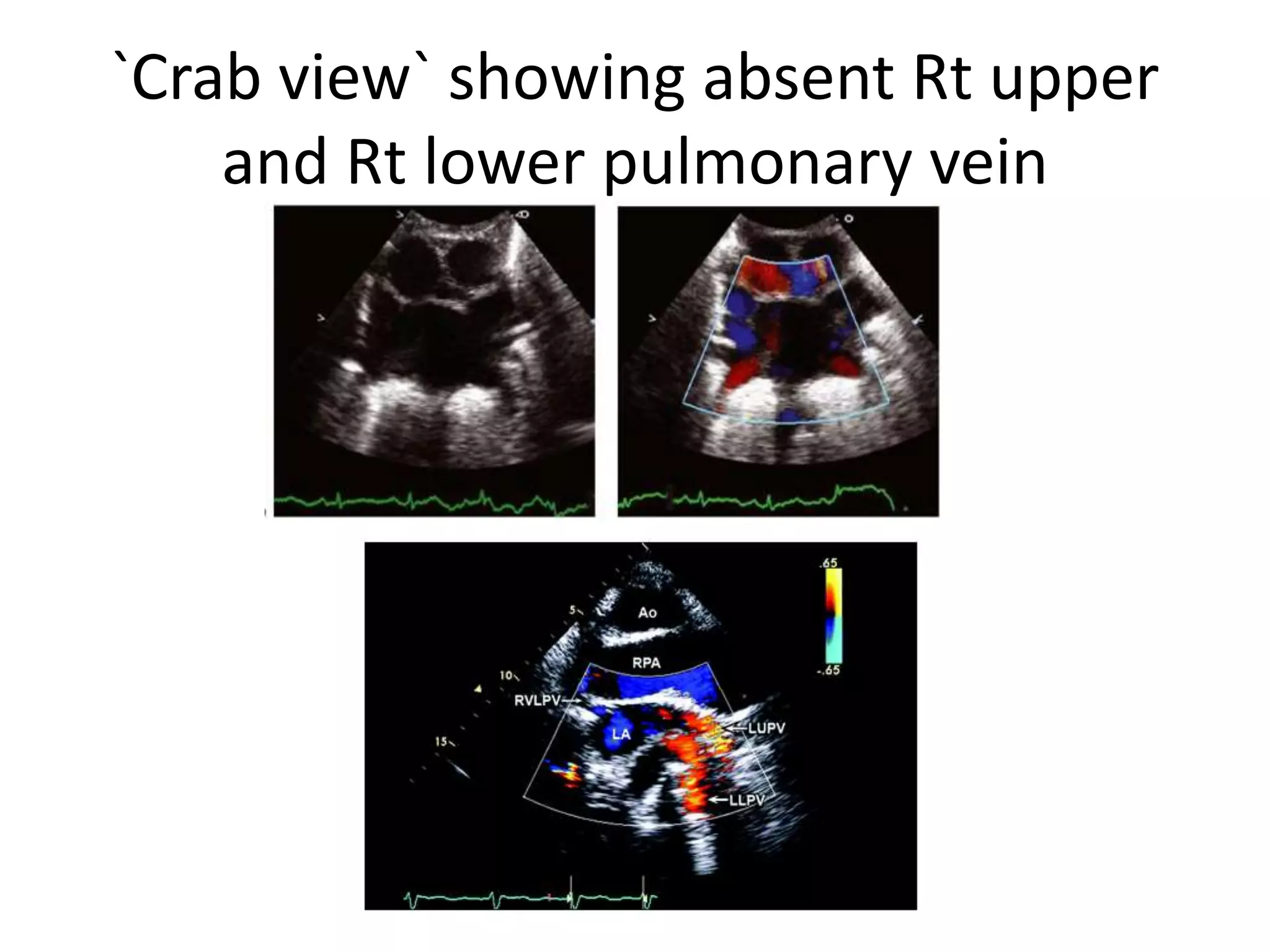 `Crab view` showing absent Rt upper
and Rt lower pulmonary vein
 