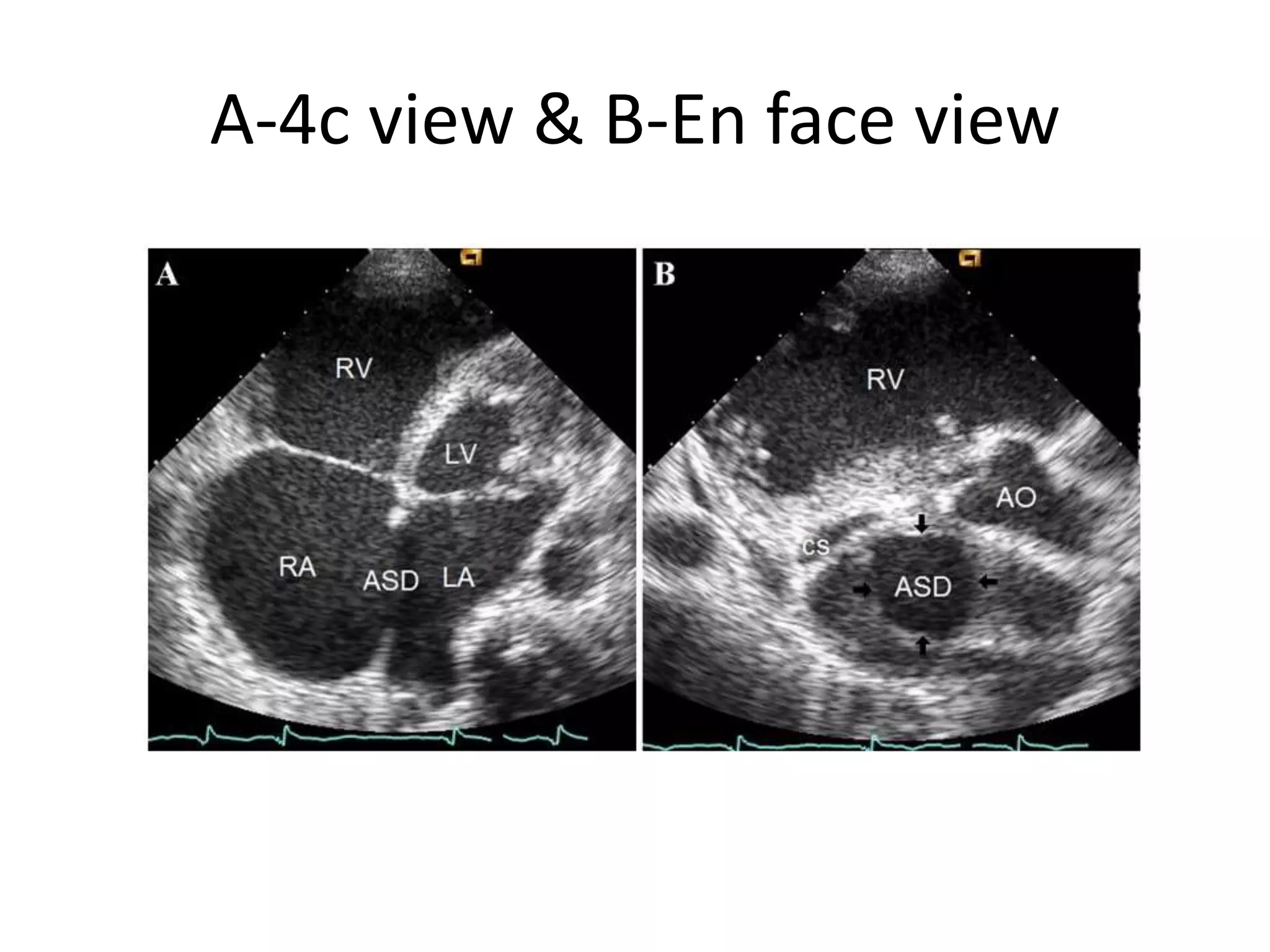 A-4c view & B-En face view
 