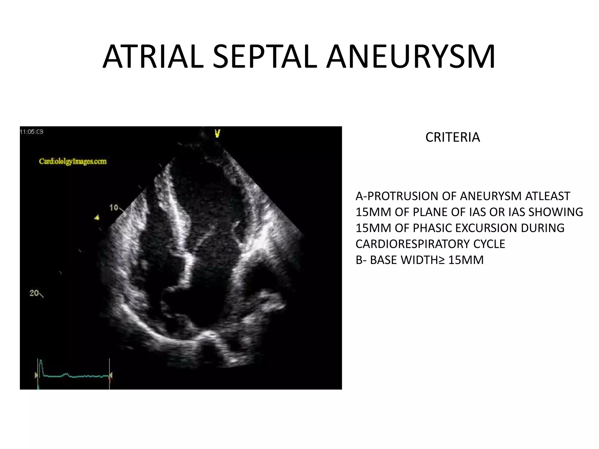 ATRIAL SEPTAL ANEURYSM
CRITERIA
A-PROTRUSION OF ANEURYSM ATLEAST
15MM OF PLANE OF IAS OR IAS SHOWING
15MM OF PHASIC EXCURSION DURING
CARDIORESPIRATORY CYCLE
B- BASE WIDTH≥ 15MM
 