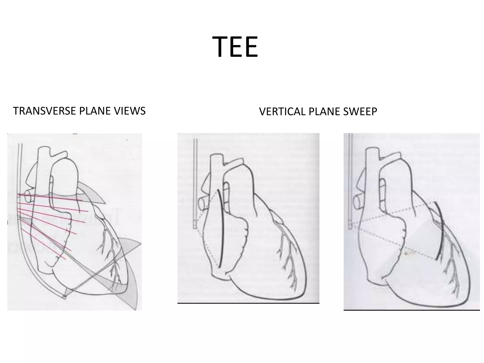 TRANSVERSE PLANE VIEWS VERTICAL PLANE SWEEP
TEE
 
