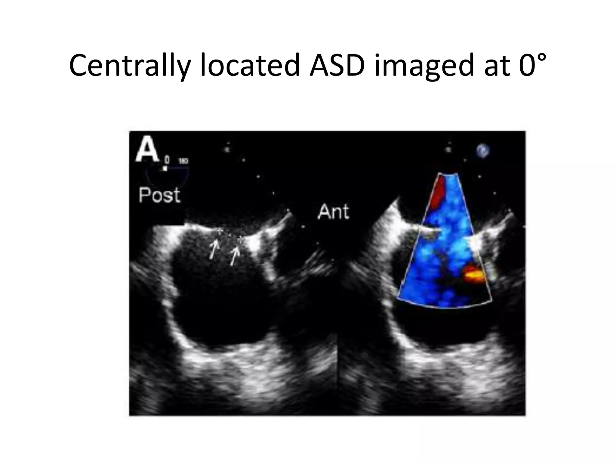Centrally located ASD imaged at 0°
 