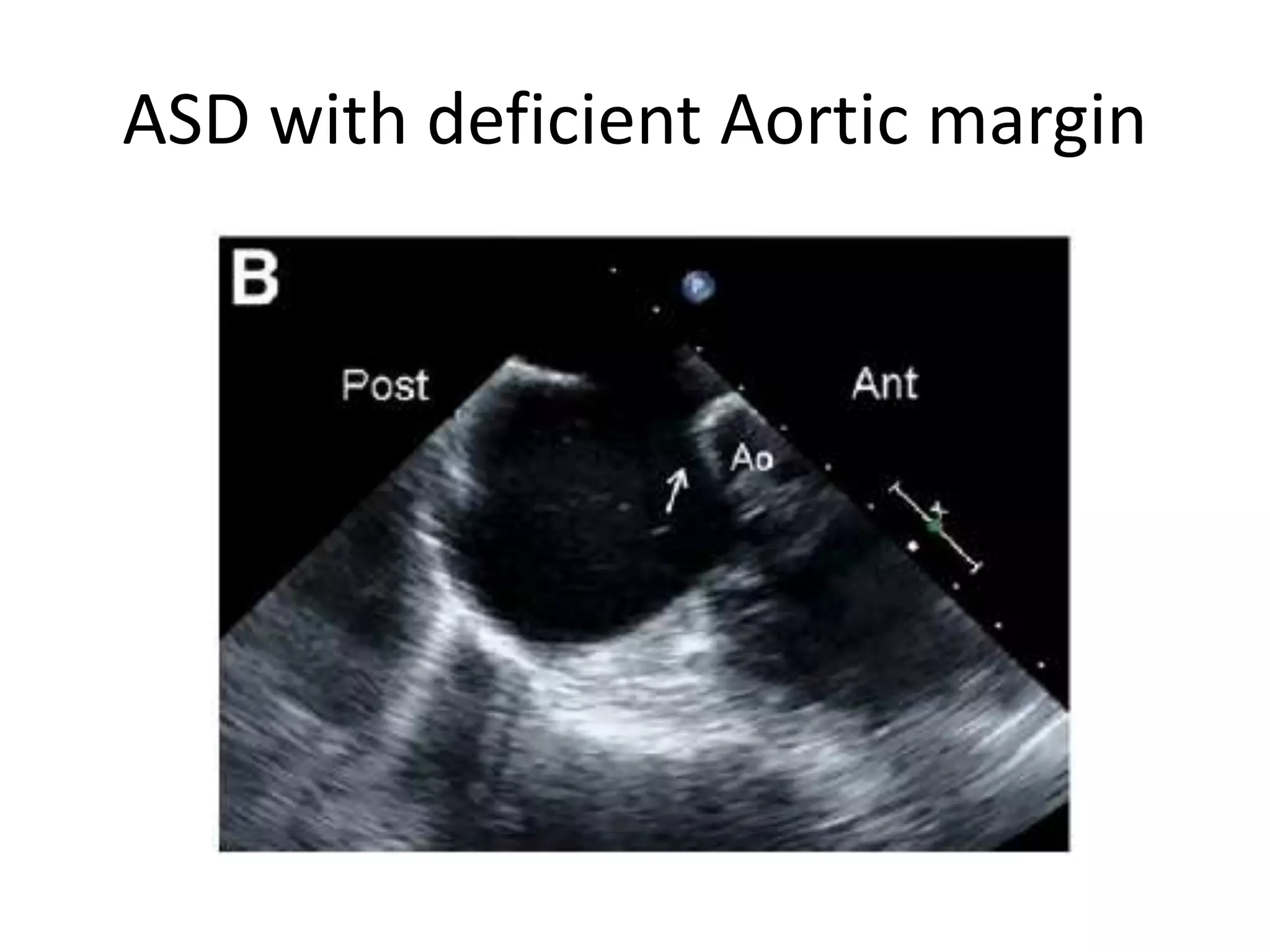 ASD with deficient Aortic margin
 