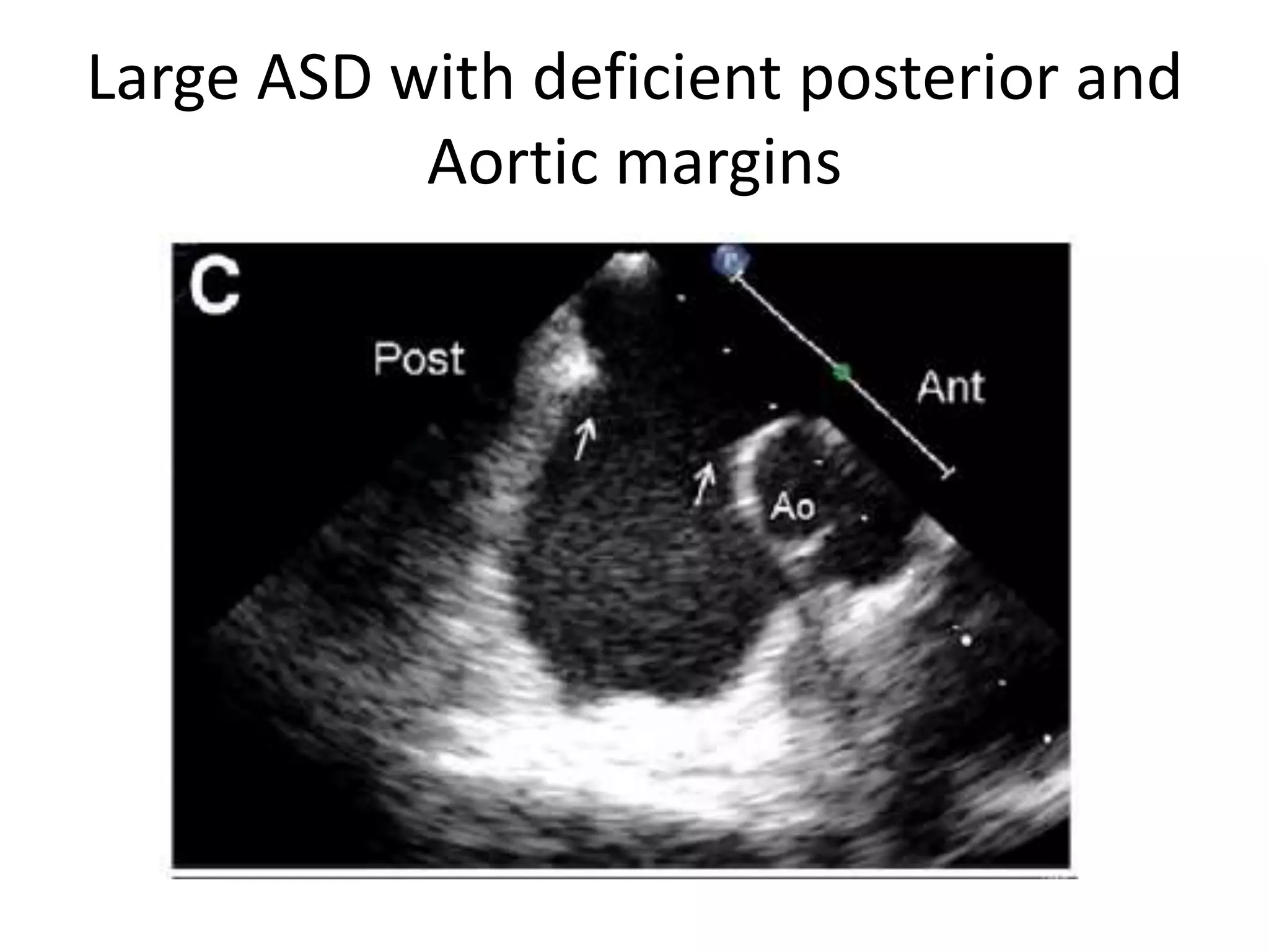 Large ASD with deficient posterior and
Aortic margins
 