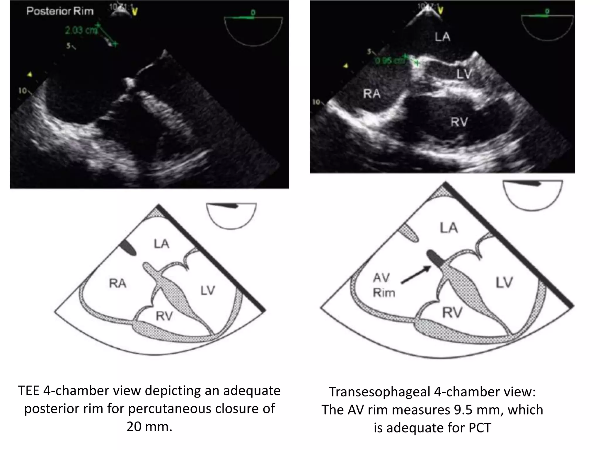 TEE 4-chamber view depicting an adequate
posterior rim for percutaneous closure of
20 mm.
Transesophageal 4-chamber view:
The AV rim measures 9.5 mm, which
is adequate for PCT
 