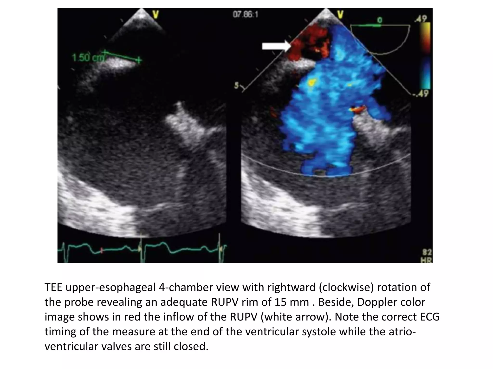 TEE upper-esophageal 4-chamber view with rightward (clockwise) rotation of
the probe revealing an adequate RUPV rim of 15 mm . Beside, Doppler color
image shows in red the inflow of the RUPV (white arrow). Note the correct ECG
timing of the measure at the end of the ventricular systole while the atrio-
ventricular valves are still closed.
 