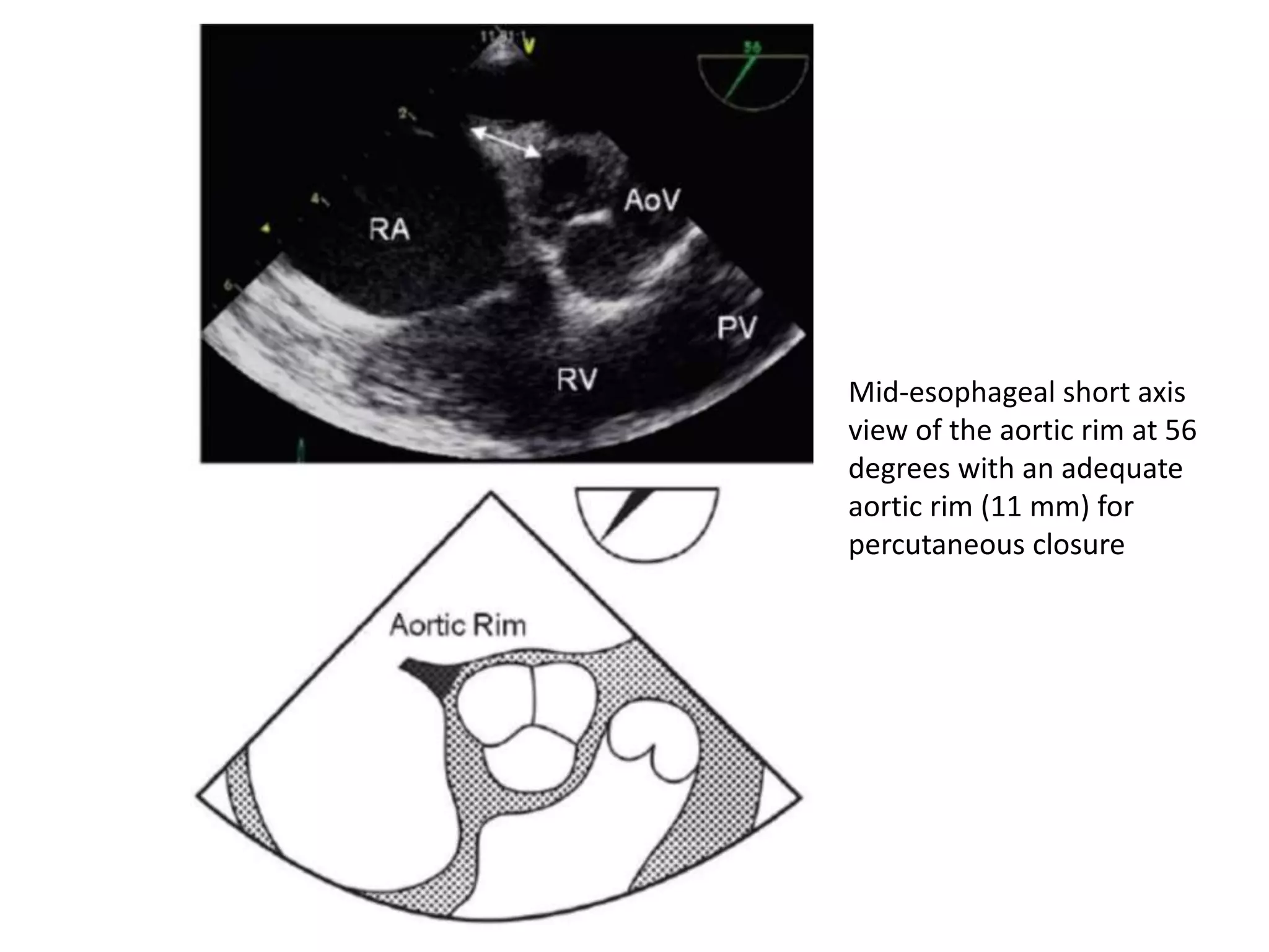 Mid-esophageal short axis
view of the aortic rim at 56
degrees with an adequate
aortic rim (11 mm) for
percutaneous closure
 