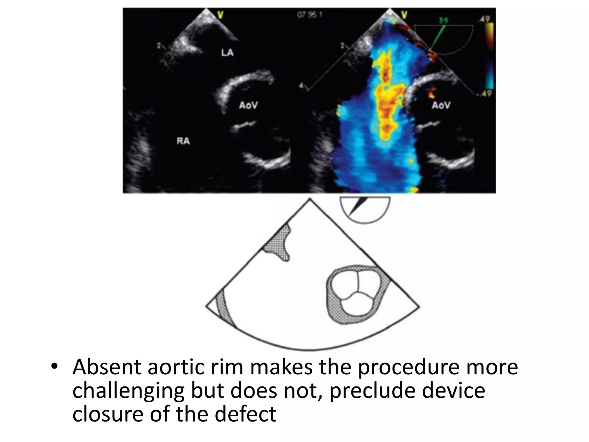 • Absent aortic rim makes the procedure more
challenging but does not, preclude device
closure of the defect
 
