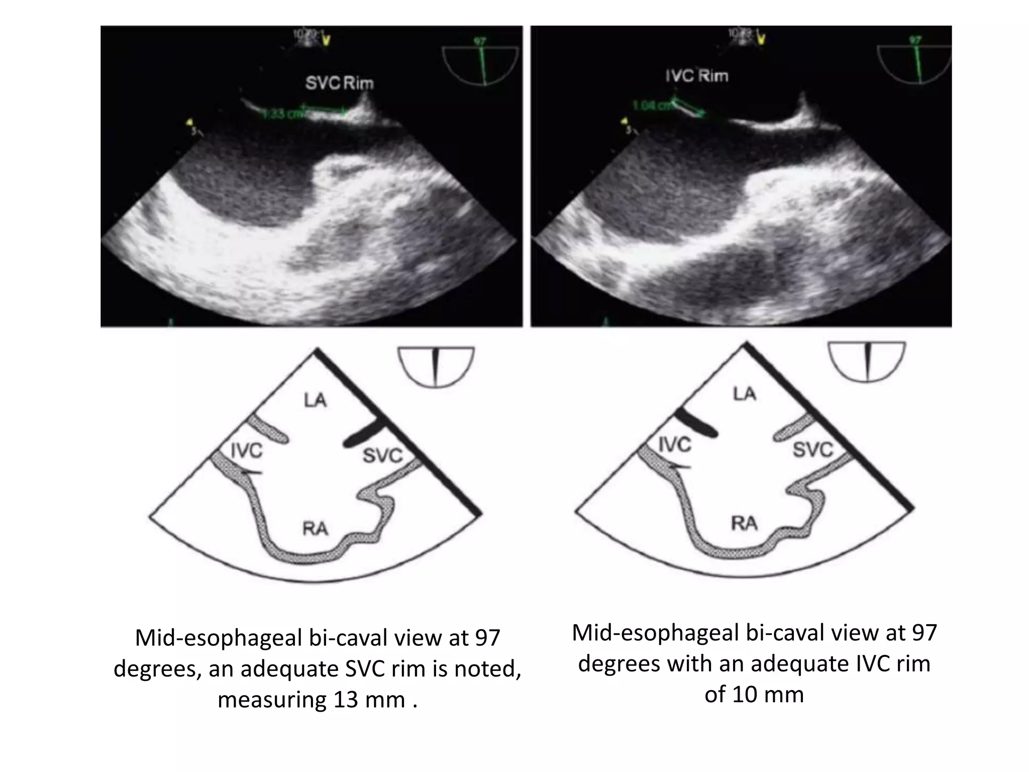 Mid-esophageal bi-caval view at 97
degrees, an adequate SVC rim is noted,
measuring 13 mm .
Mid-esophageal bi-caval view at 97
degrees with an adequate IVC rim
of 10 mm
 