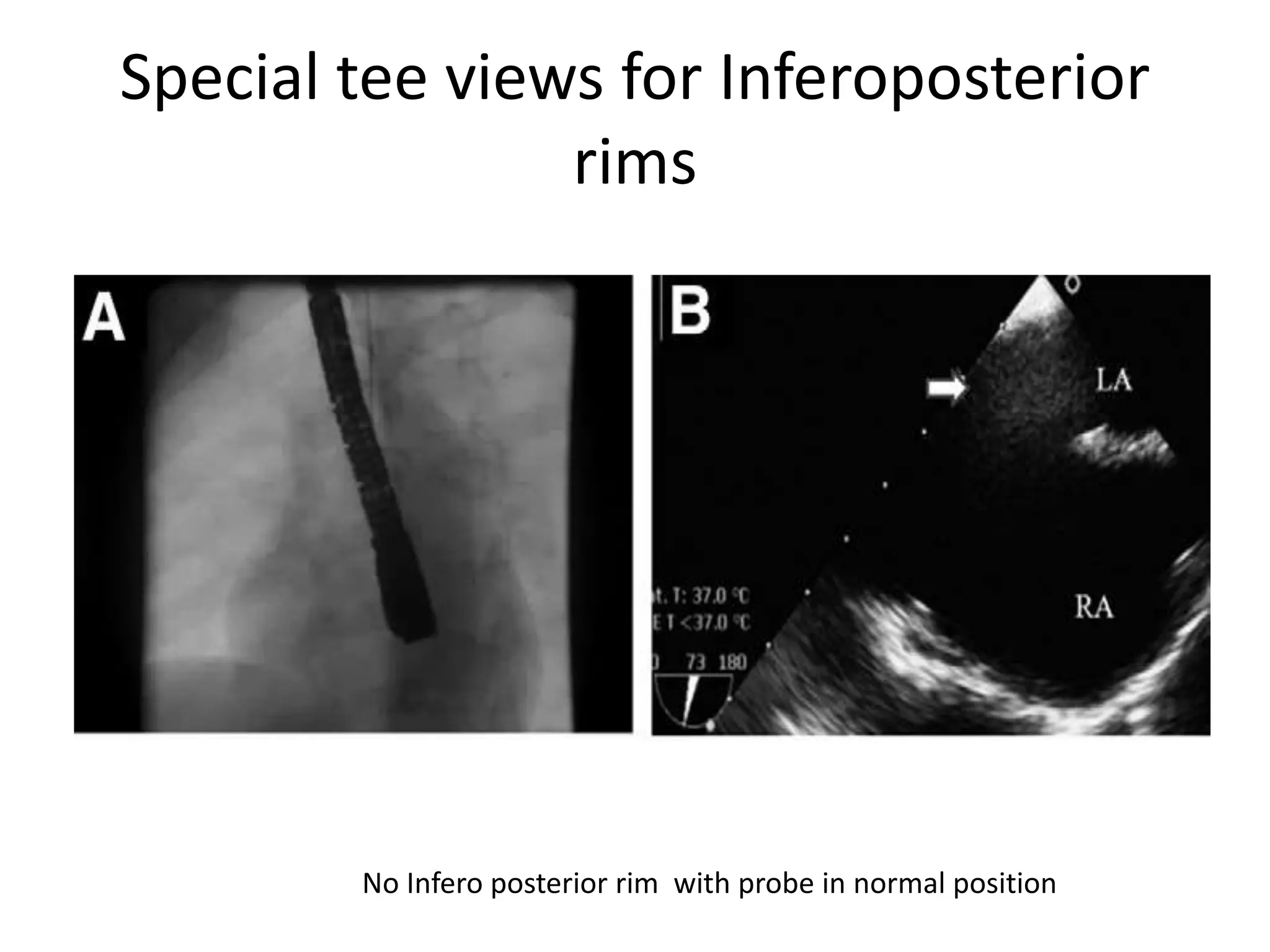 Special tee views for Inferoposterior
rims
No Infero posterior rim with probe in normal position
 