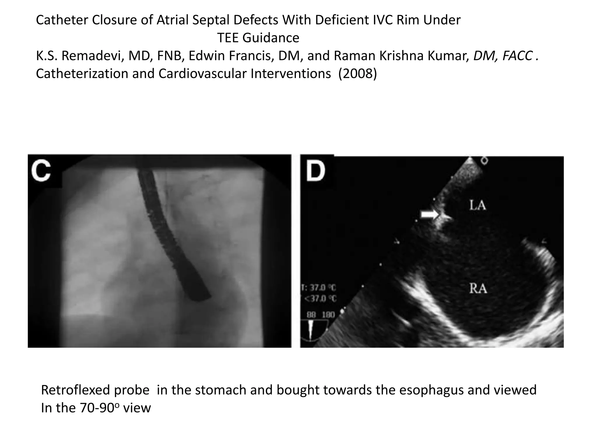 Catheter Closure of Atrial Septal Defects With Deficient IVC Rim Under
TEE Guidance
K.S. Remadevi, MD, FNB, Edwin Francis, DM, and Raman Krishna Kumar, DM, FACC .
Catheterization and Cardiovascular Interventions (2008)
Retroflexed probe in the stomach and bought towards the esophagus and viewed
In the 70-90o view
 