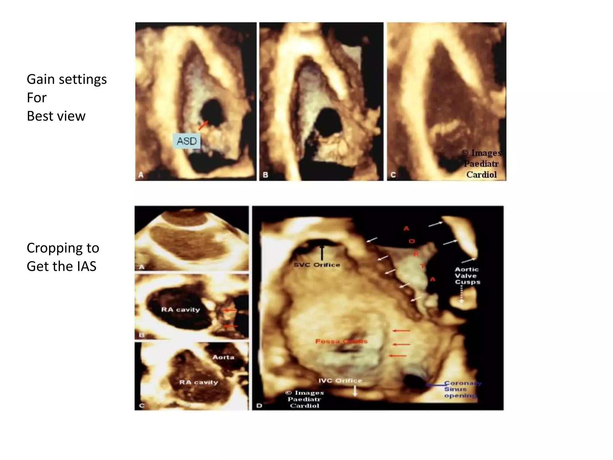 Gain settings
For
Best view
Cropping to
Get the IAS
 
