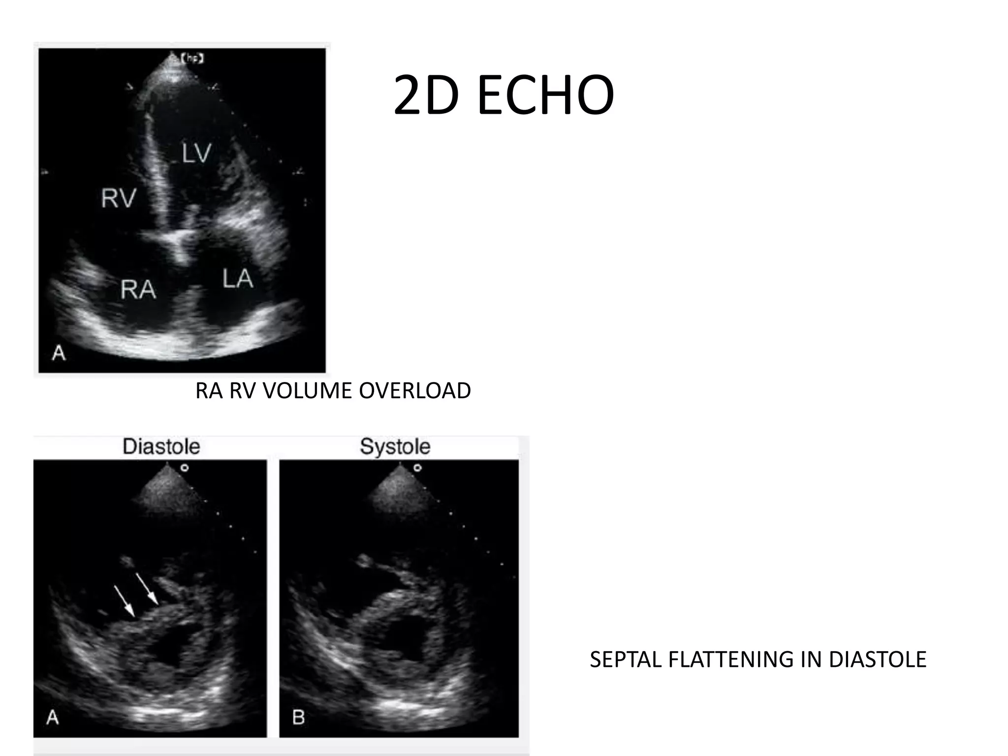 2D ECHO
RA RV VOLUME OVERLOAD
SEPTAL FLATTENING IN DIASTOLE
 