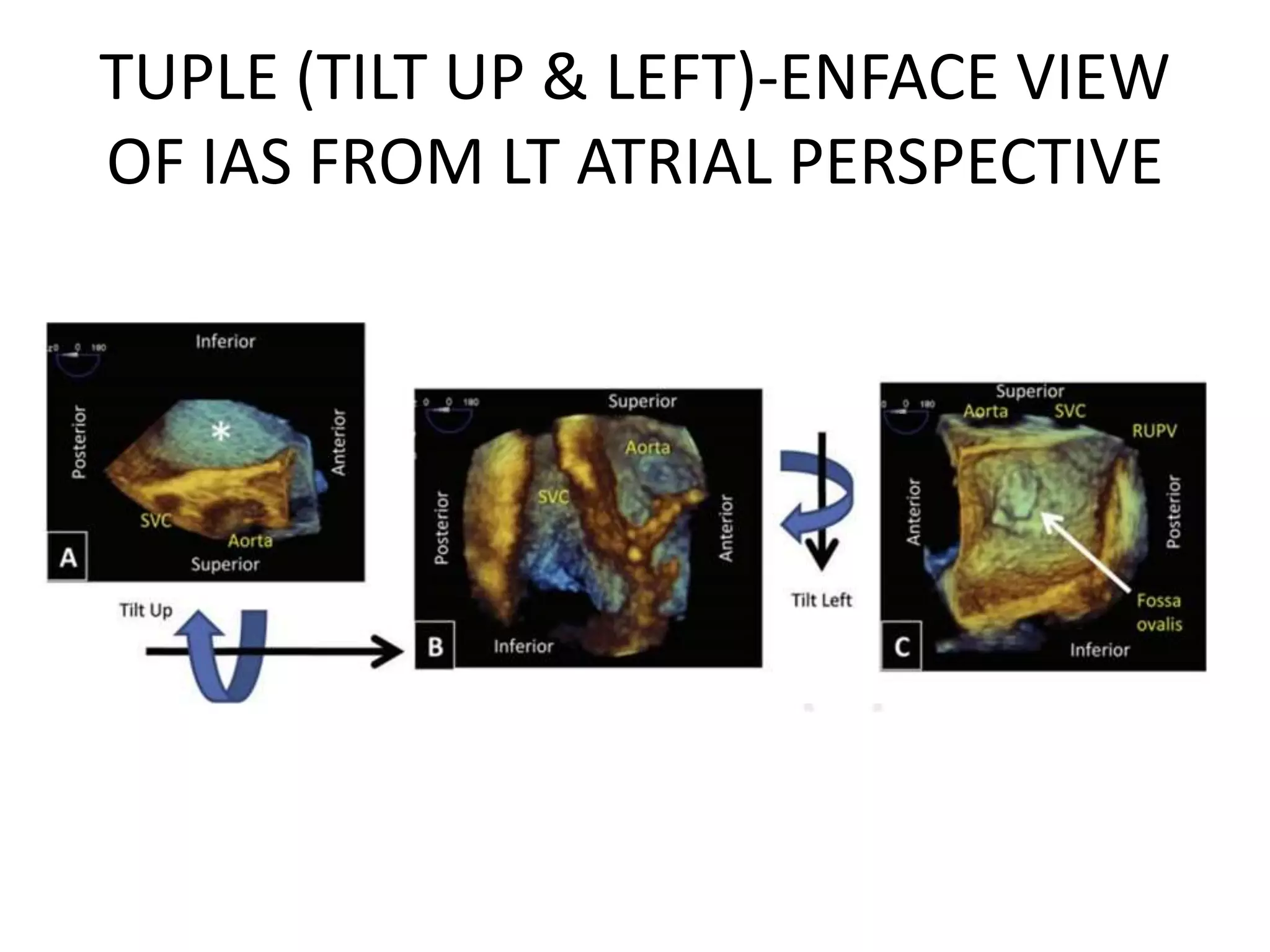 TUPLE (TILT UP & LEFT)-ENFACE VIEW
OF IAS FROM LT ATRIAL PERSPECTIVE
 