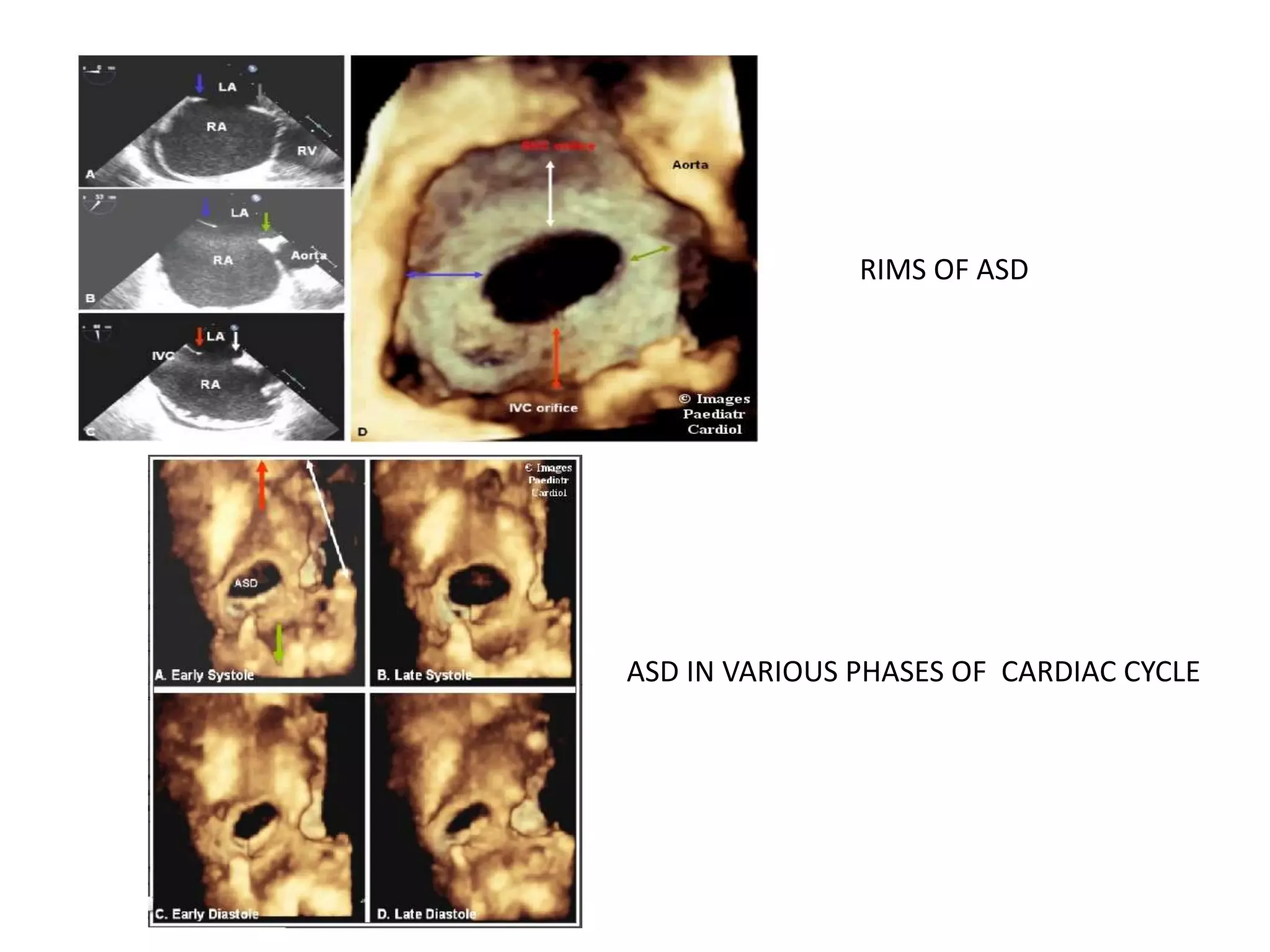 RIMS OF ASD
ASD IN VARIOUS PHASES OF CARDIAC CYCLE
 