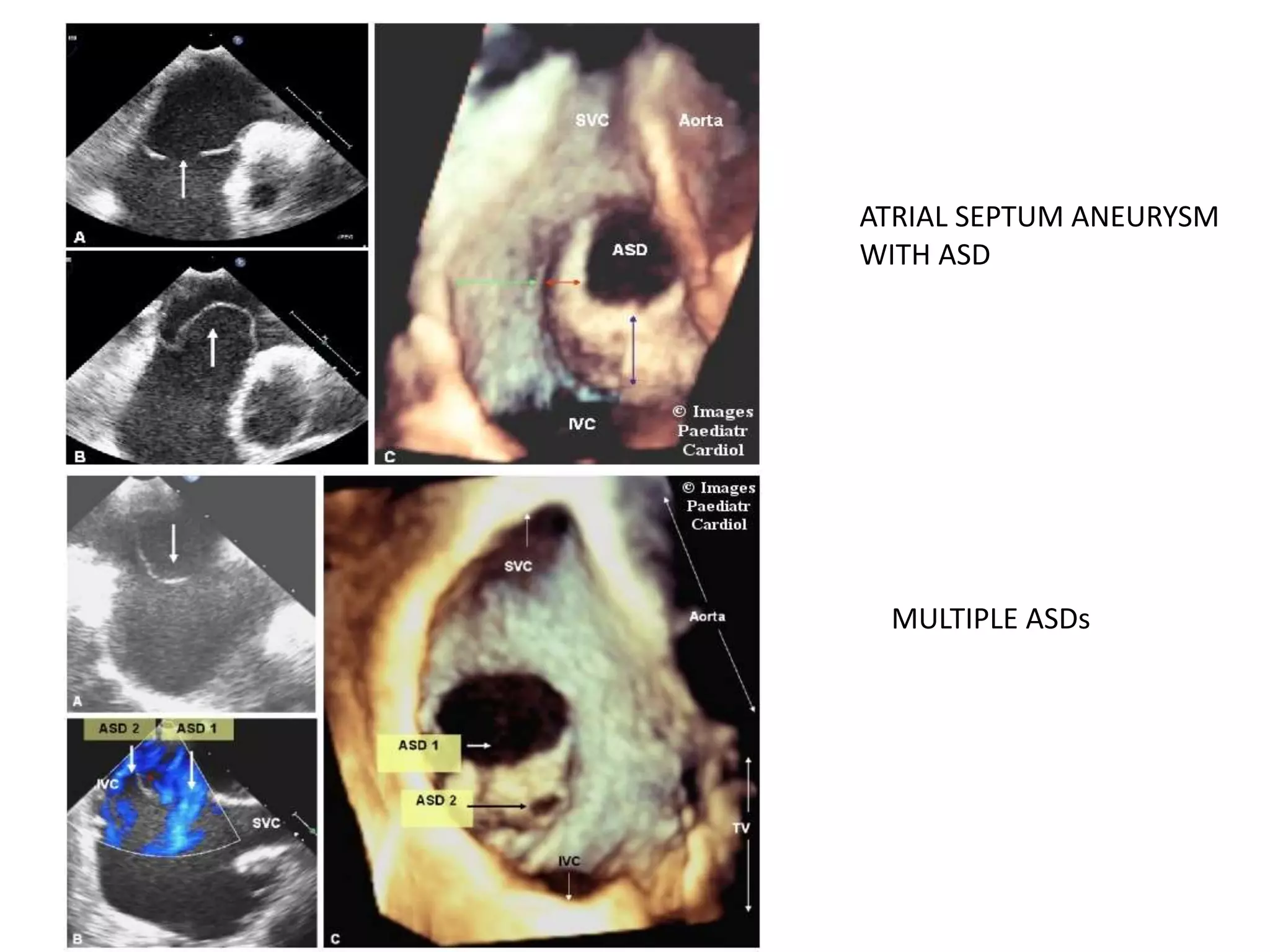 ATRIAL SEPTUM ANEURYSM
WITH ASD
MULTIPLE ASDs
 