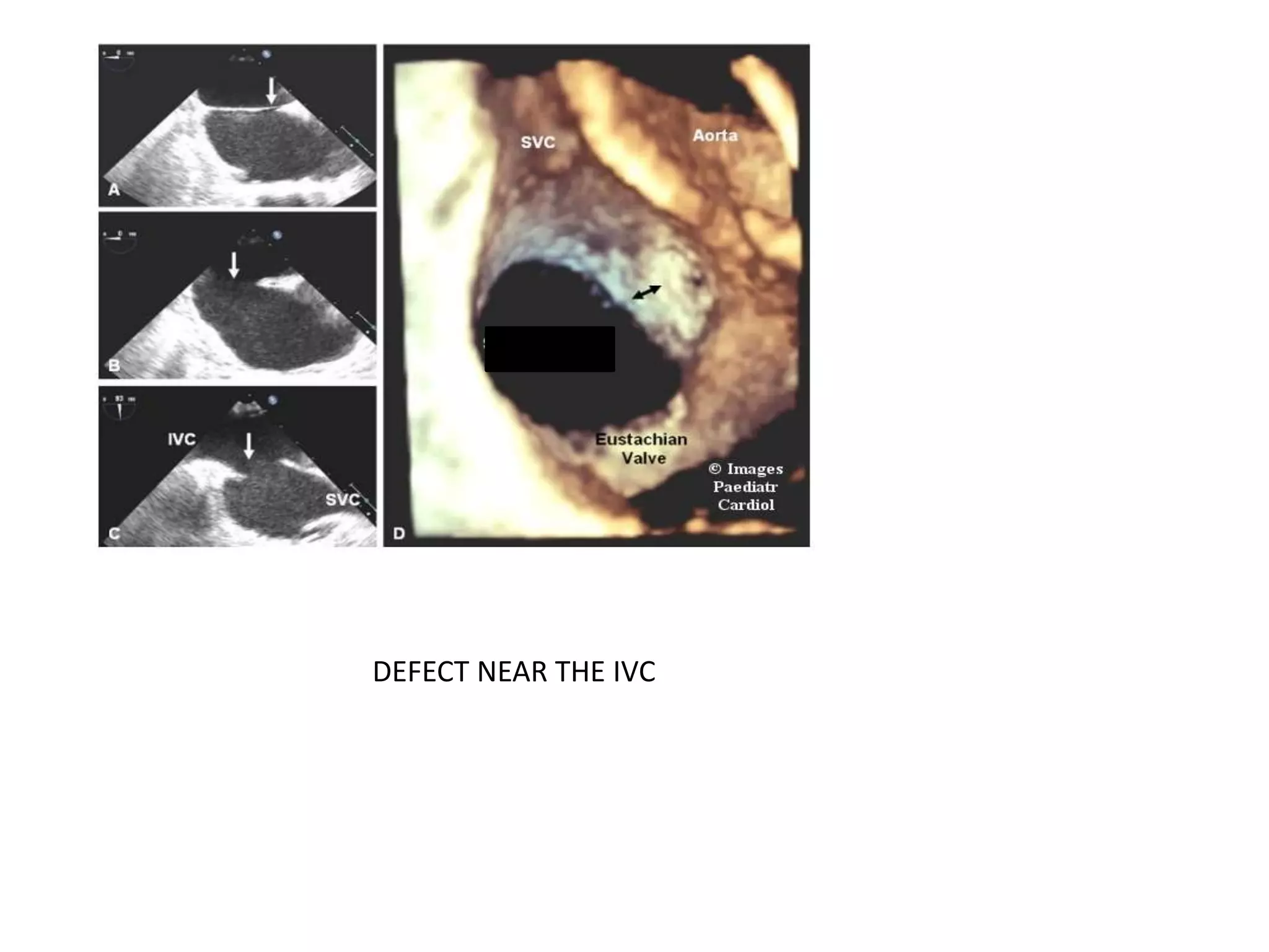 DEFECT NEAR THE IVC
 
