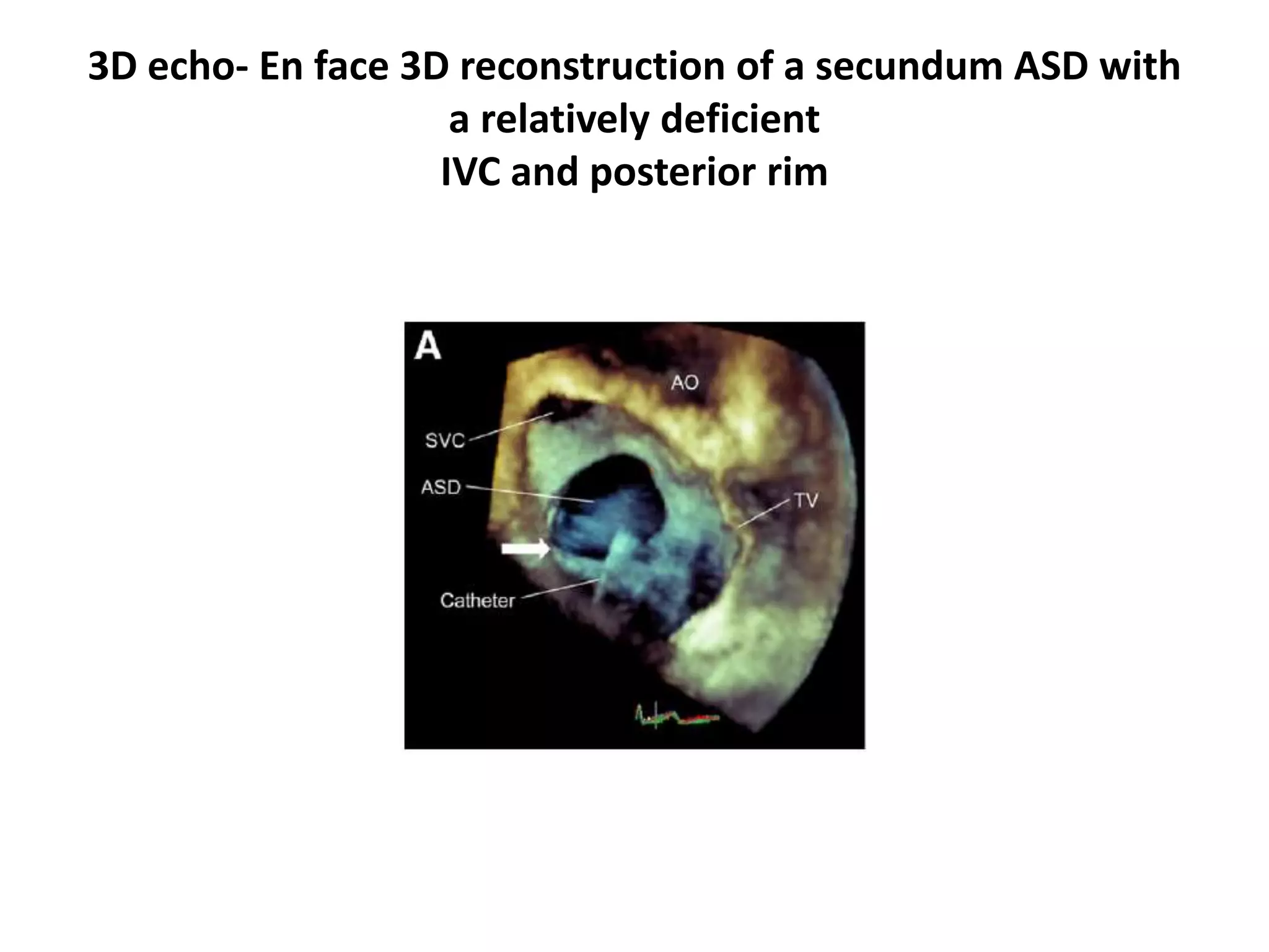 3D echo- En face 3D reconstruction of a secundum ASD with
a relatively deficient
IVC and posterior rim
 