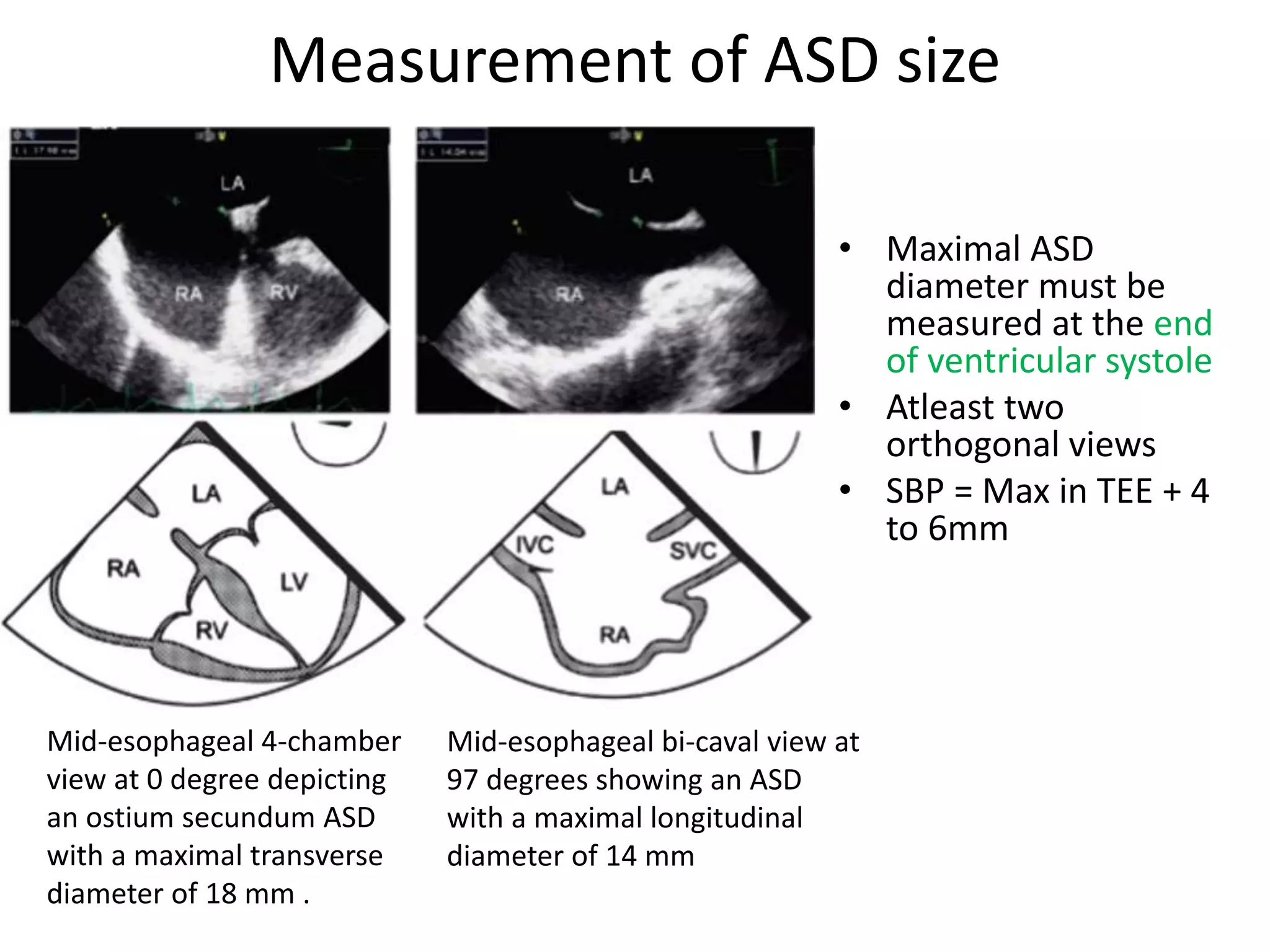 Measurement of ASD size
• Maximal ASD
diameter must be
measured at the end
of ventricular systole
• Atleast two
orthogonal views
• SBP = Max in TEE + 4
to 6mm
Mid-esophageal 4-chamber
view at 0 degree depicting
an ostium secundum ASD
with a maximal transverse
diameter of 18 mm .
Mid-esophageal bi-caval view at
97 degrees showing an ASD
with a maximal longitudinal
diameter of 14 mm
 