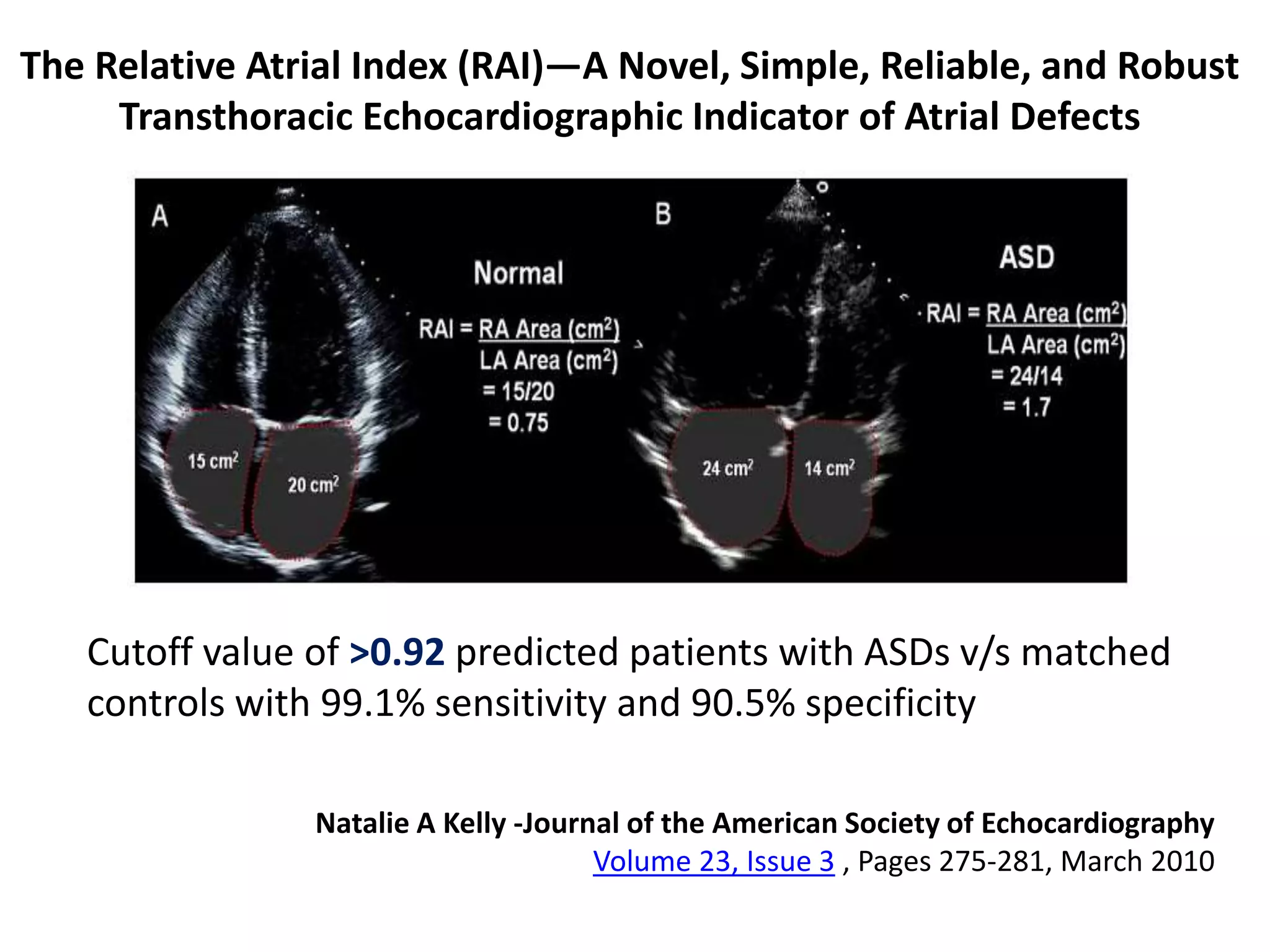 The Relative Atrial Index (RAI)—A Novel, Simple, Reliable, and Robust
Transthoracic Echocardiographic Indicator of Atrial Defects
Cutoff value of >0.92 predicted patients with ASDs v/s matched
controls with 99.1% sensitivity and 90.5% specificity
Natalie A Kelly -Journal of the American Society of Echocardiography
Volume 23, Issue 3 , Pages 275-281, March 2010
 