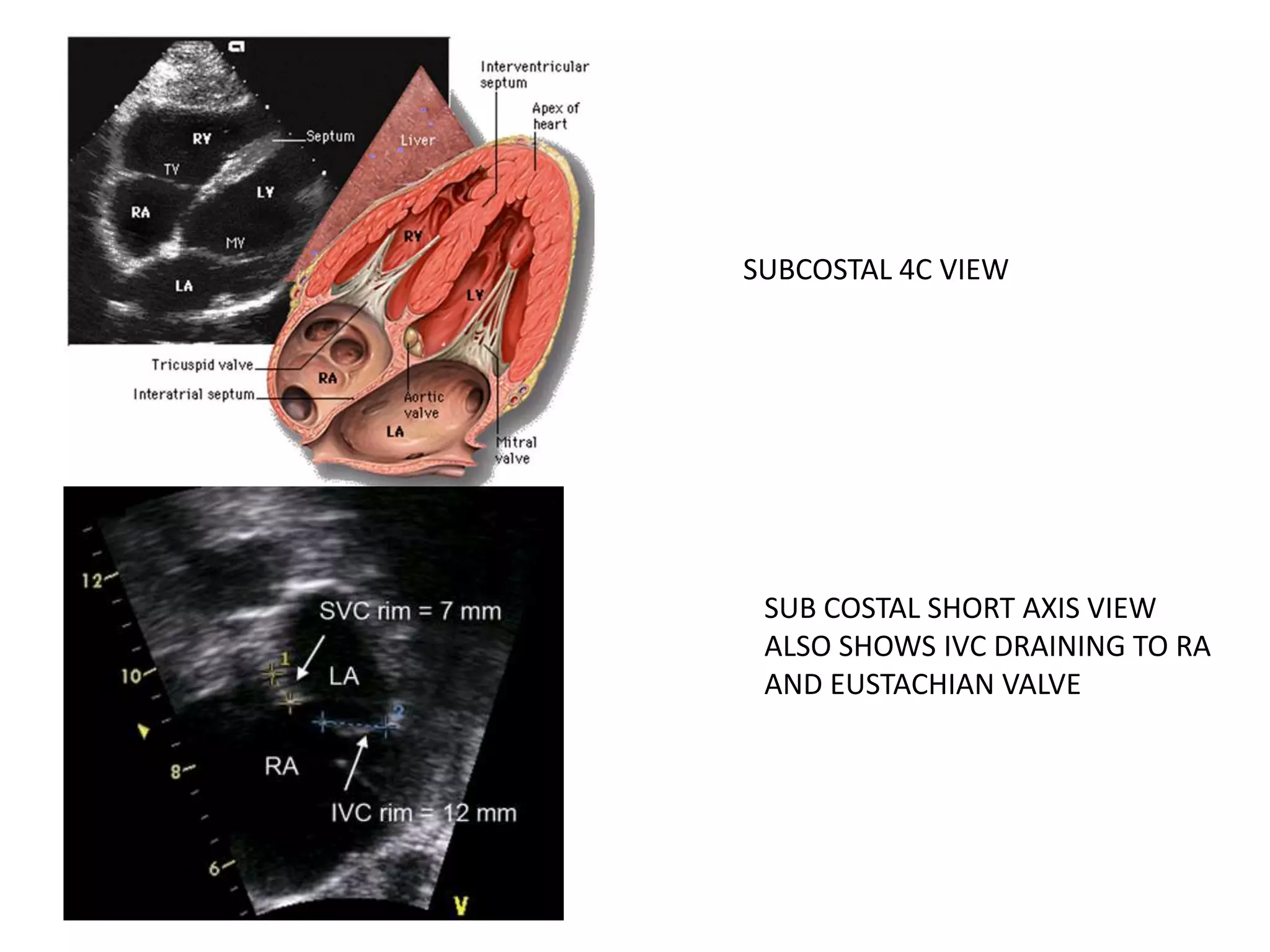 SUBCOSTAL 4C VIEW
SUB COSTAL SHORT AXIS VIEW
ALSO SHOWS IVC DRAINING TO RA
AND EUSTACHIAN VALVE
 