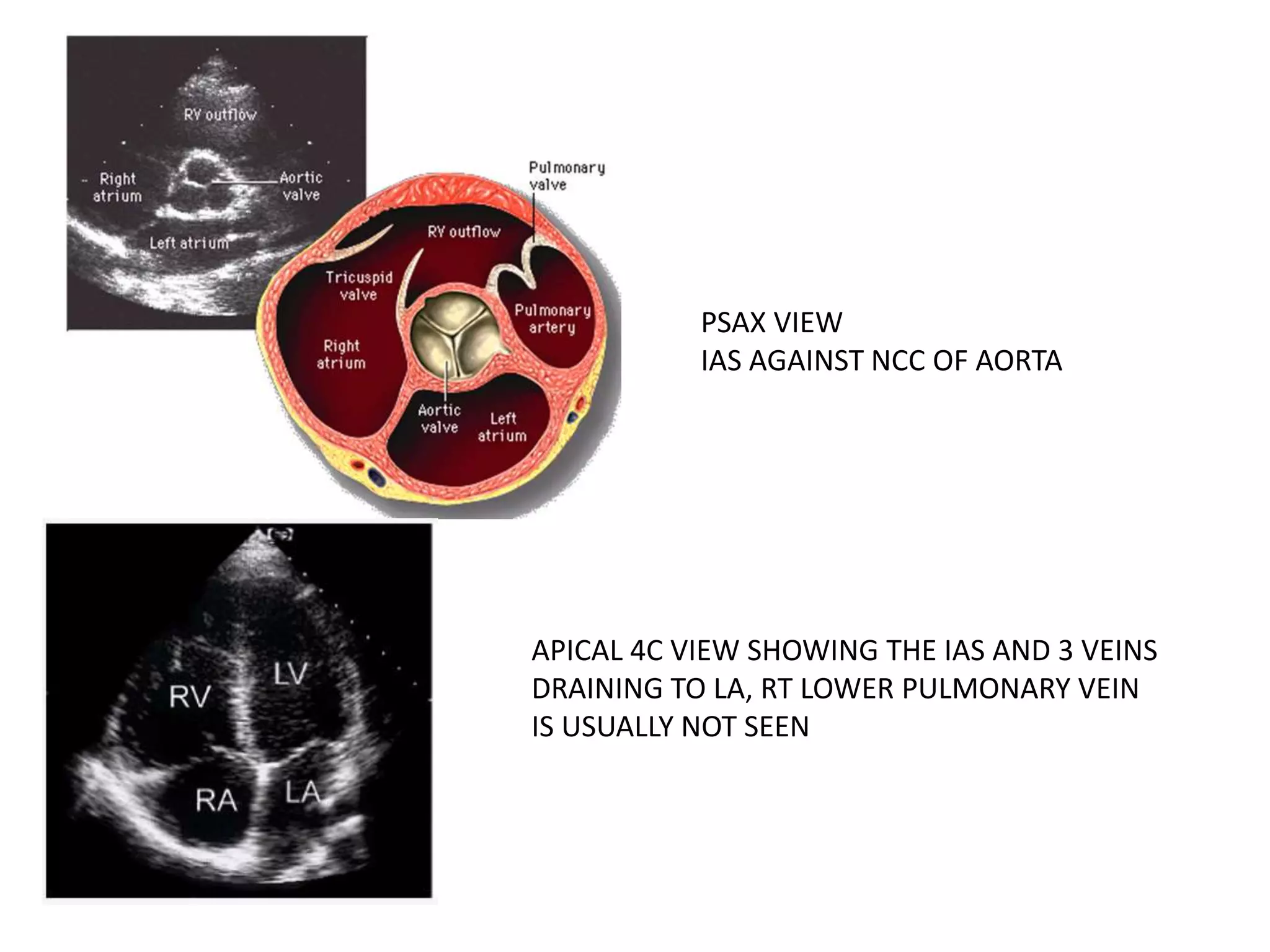 PSAX VIEW
IAS AGAINST NCC OF AORTA
APICAL 4C VIEW SHOWING THE IAS AND 3 VEINS
DRAINING TO LA, RT LOWER PULMONARY VEIN
IS USUALLY NOT SEEN
 