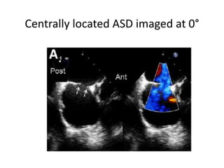 ECHO ASSESSMENT OF ASD FOR DEVICE CLOSURE | PPTX