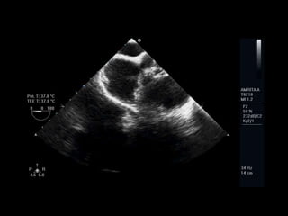 ECHO ASSESSMENT OF ASD FOR DEVICE CLOSURE | PPTX