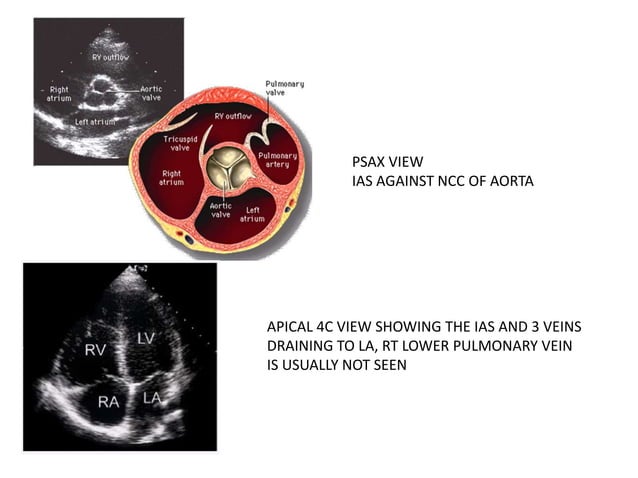 ECHO ASSESSMENT OF ASD FOR DEVICE CLOSURE | PPTX | 3-D Graphics ...