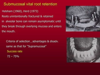 Submucosal vital root retention
Helsham (1960), Herd (1973)
Roots unintentionally fractured & retained
in alveolar bone can remain asymptomatic until
they break through overlying mucosa and enters
the mouth.
Criteria of selection , advantages & disadv.
same as that for “Supramucosal”
Success rate
72 – 75%
 