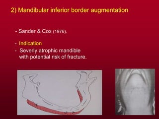 2) Mandibular inferior border augmentation
- Sander & Cox (1976).
- Indication
- Severly atrophic mandible
with potential risk of fracture.
 