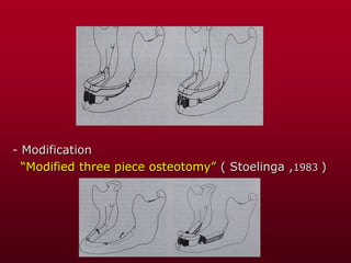 - Modification
“Modified three piece osteotomy” ( Stoelinga ,1983 )
 