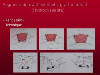 Augmentation with synthetic graft material
(Hydroxyapatite)
- Kent (1983).
- Technique
 