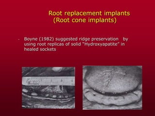 Root replacement implants
(Root cone implants)
- Boyne (1982) suggested ridge preservation by
using root replicas of solid “Hydroxyapatite” in
healed sockets
 