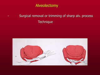 Alveolectomy
- Surgical removal or trimming of sharp alv. process
Technique
 