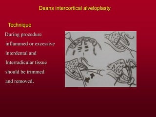 Deans intercortical alveloplasty
Technique
During procedure
inflammed or excessive
interdental and
Interradicular tissue
should be trimmed
and removed.
 