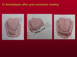 4) Alveloplasty after post extraction healing
 