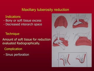 Maxillary tuberosity reduction
Indications
- Bony or soft tissue excess
- Decreased interarch space
Technique
Amount of soft tissue for reduction
evaluated Radiographically.
Complication
- Sinus perforation
 