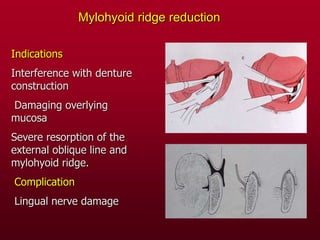 Mylohyoid ridge reduction
Indications
Interference with denture
construction
Damaging overlying
mucosa
Severe resorption of the
external oblique line and
mylohyoid ridge.
Complication
Lingual nerve damage
 