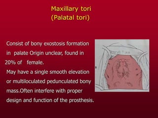 Maxillary tori
(Palatal tori)
Consist of bony exostosis formation
in palate Origin unclear, found in
20% of female.
May have a single smooth elevation
or multiloculated pedunculated bony
mass.Often interfere with proper
design and function of the prosthesis.
 