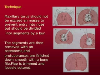 Technique
Maxillary torus should not
be excised en masse to
prevent entry into nose
but should be divided
into segments by a bur.
The segments are then
removed with an
osteotome,and
protuberances are finished
down smooth with a bone
file.Flap is trimmed and
loosely sutured.
 