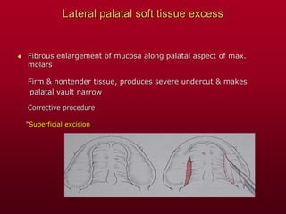 Lateral palatal soft tissue excess
 Fibrous enlargement of mucosa along palatal aspect of max.
molars
Firm & nontender tissue, produces severe undercut & makes
palatal vault narrow
Corrective procedure
“Superficial excision
 
