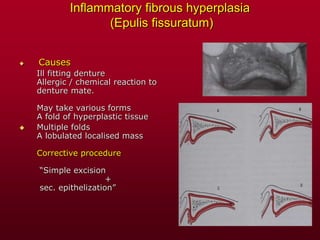 Inflammatory fibrous hyperplasia
(Epulis fissuratum)
 Causes
Ill fitting denture
Allergic / chemical reaction to
denture mate.
May take various forms
A fold of hyperplastic tissue
 Multiple folds
A lobulated localised mass
Corrective procedure
“Simple excision
+
sec. epithelization”
 