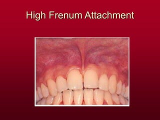 High Frenum Attachment
 