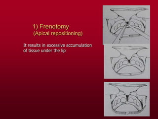 1) Frenotomy
(Apical repositioning)
It results in excessive accumulation
of tissue under the lip
 