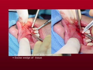 Surgical incision with #15 blade
• Excise wedge of tissue
 