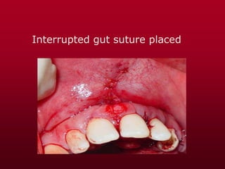 Interrupted gut suture placed
 